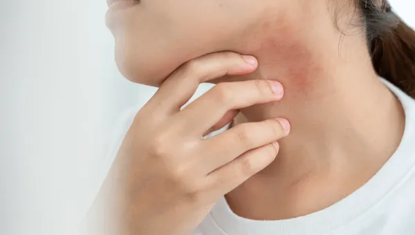 Managing Eczema in the UAE: Heat, Humidity, and Flare Triggers