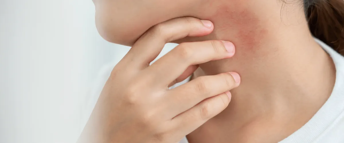 Managing Eczema in the UAE: Heat, Humidity, and Flare Triggers
